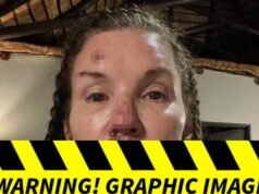 Fotos de Janice Dickinson de supuestas lesiones por una mala caída en ‘I’m a Celebrity’